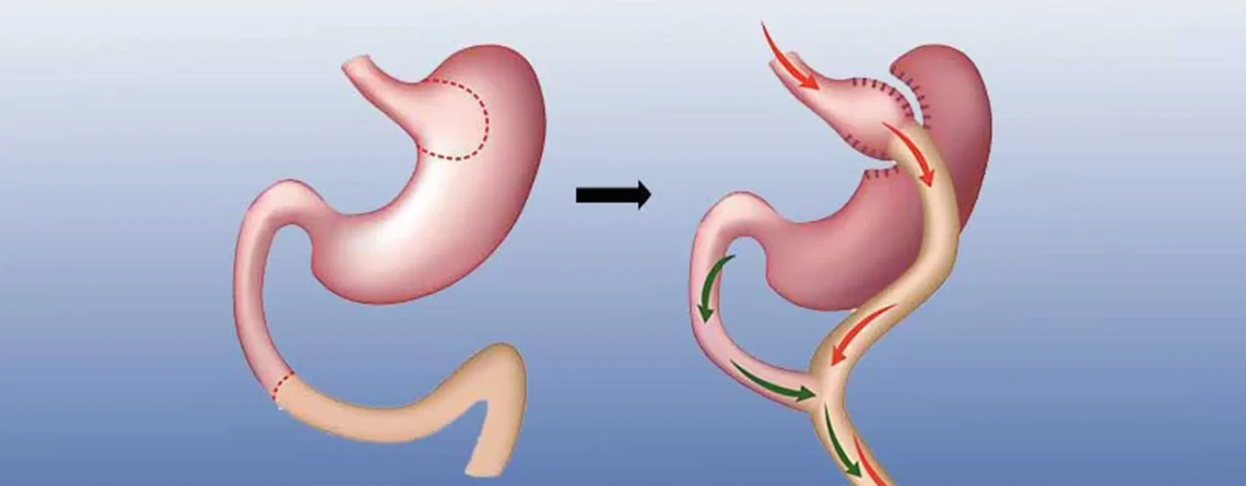 Gastric Bypass Nedir