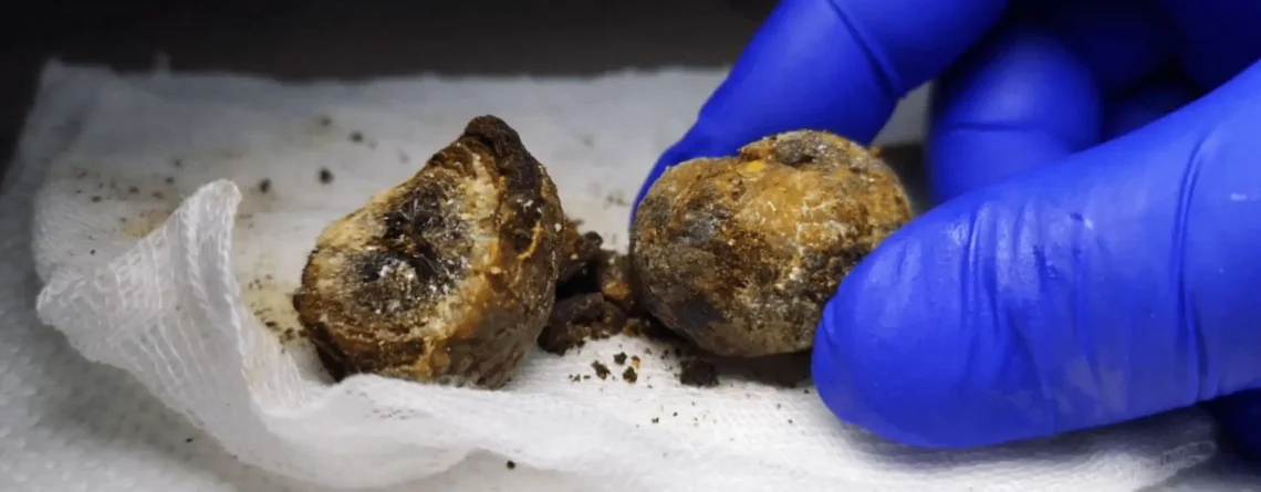 Obezite Cerrahisi ve Safra Taşı İlişkisi