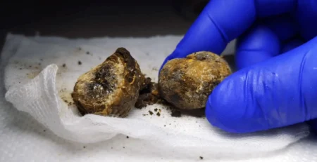 Obezite Cerrahisi ve Safra Taşı İlişkisi